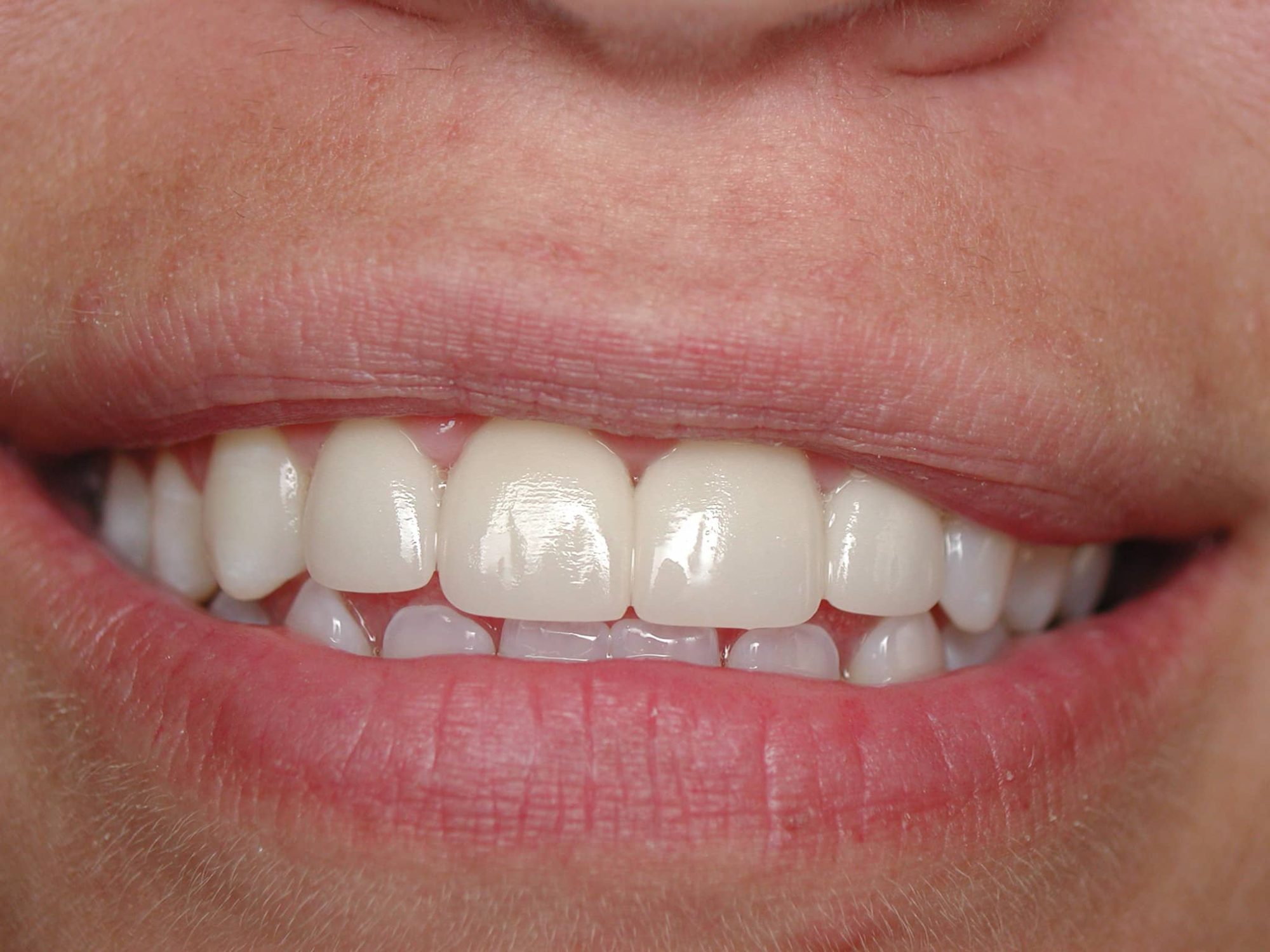 Smile Gallery — Anderson Dental
